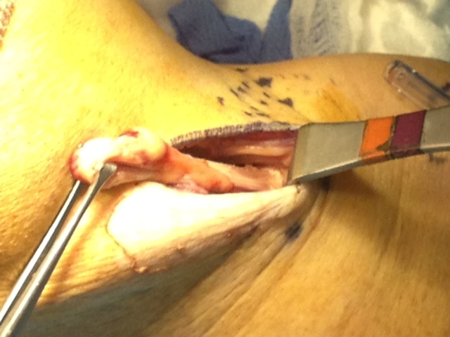 Before repair. Torn tendon